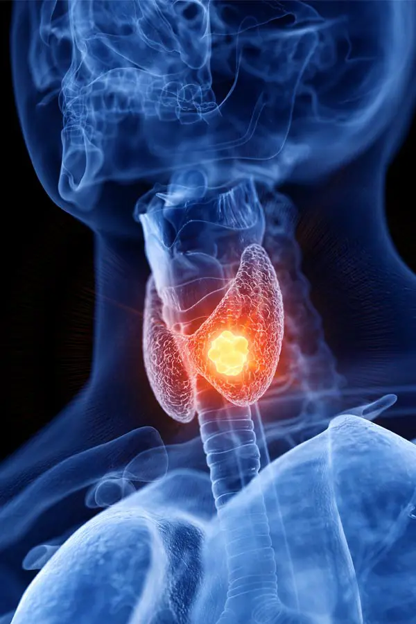 A 3D illustration of an x-ray of a human neck, highlighting the thyroid. Get help with thyroid imbalance from Carolyn Zaumeyer, MSN, APRN at LowTE Florida® in Greater Fort Lauderdale.